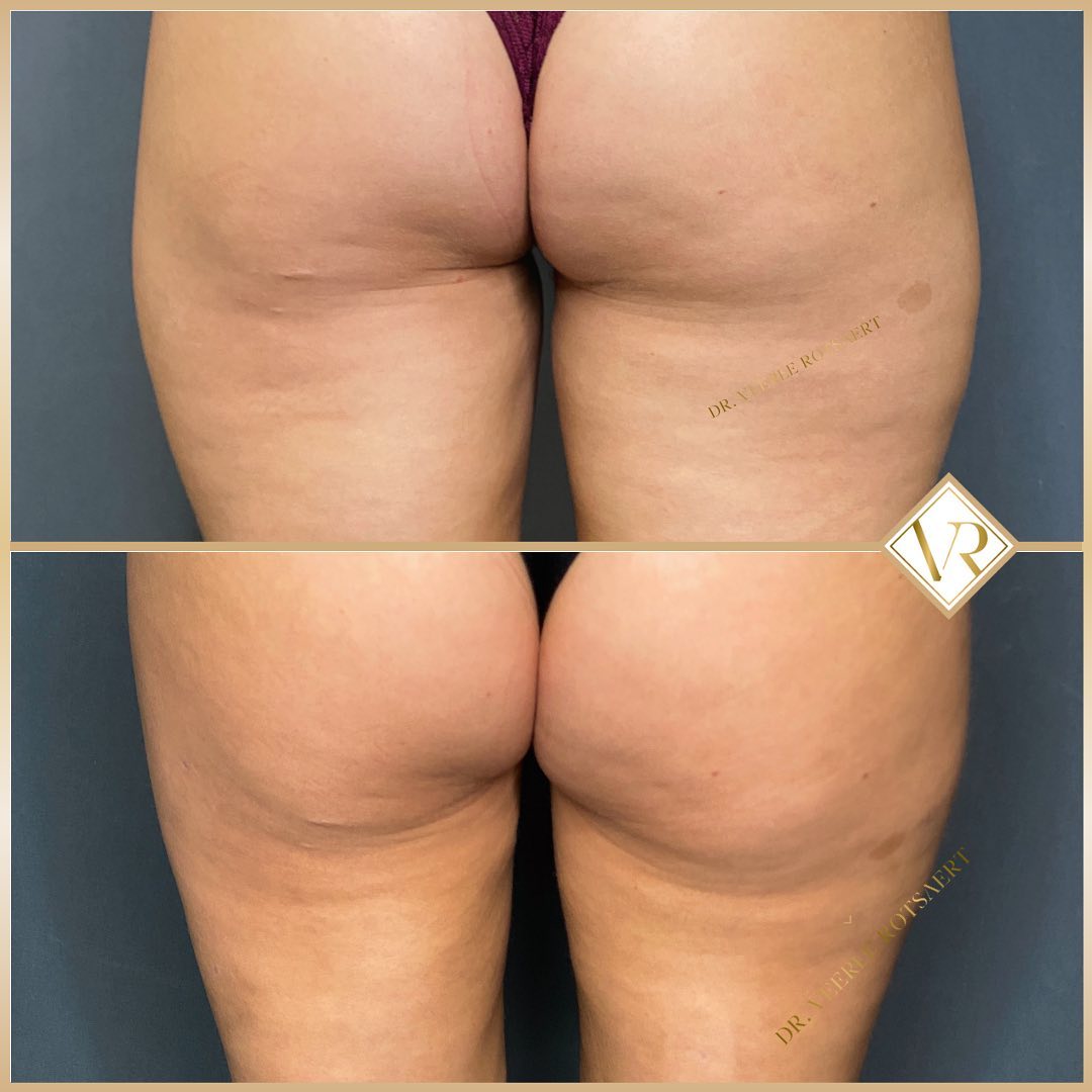 Liposuction before and after 1