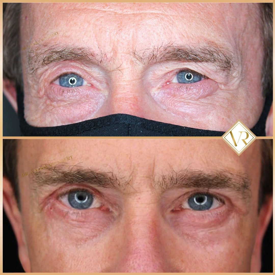 Eyelid before and after 1