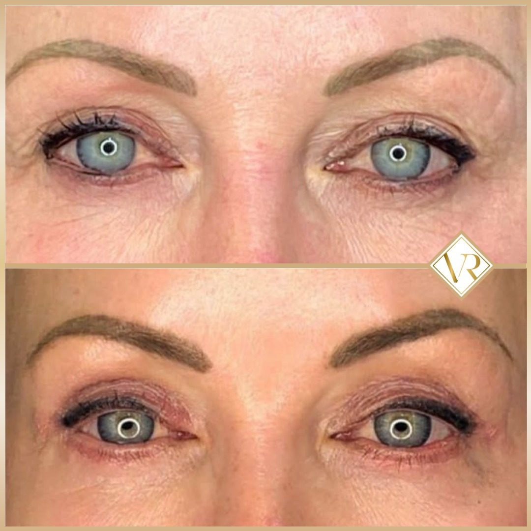 Eyelid before and after 2