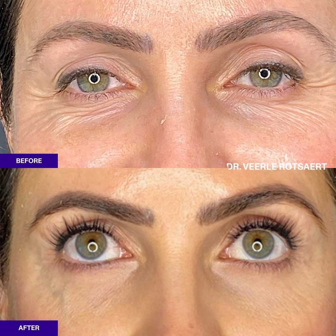 Eyelid before and after 3