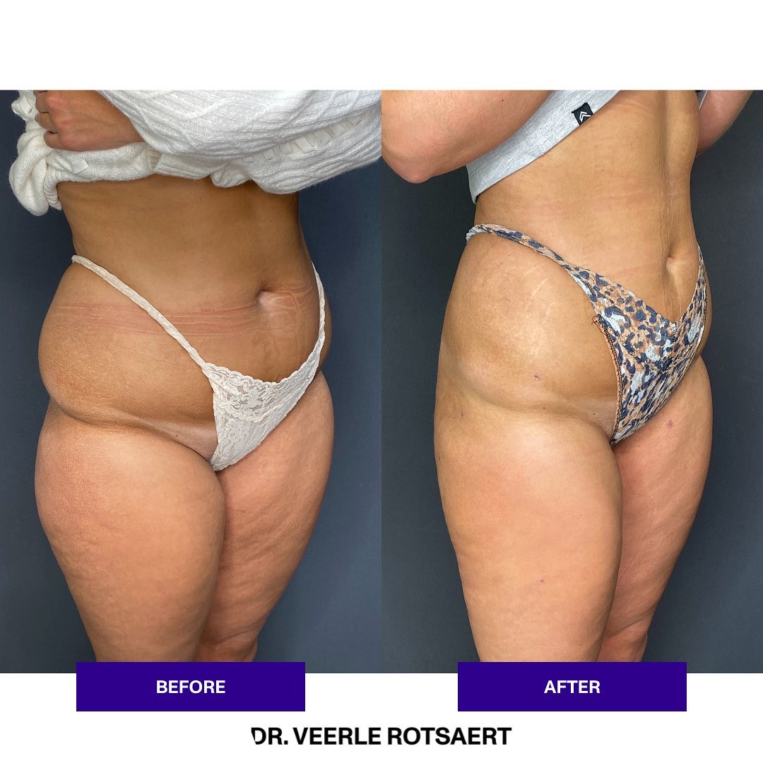 Liposuction before and after 2