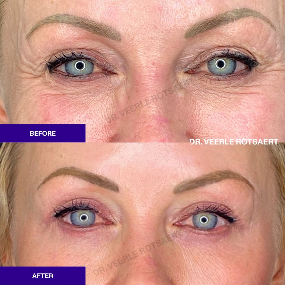 Eyelid before and after 4