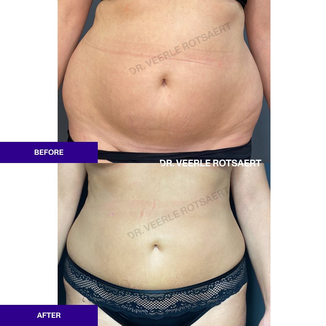 Liposuction before and after 4