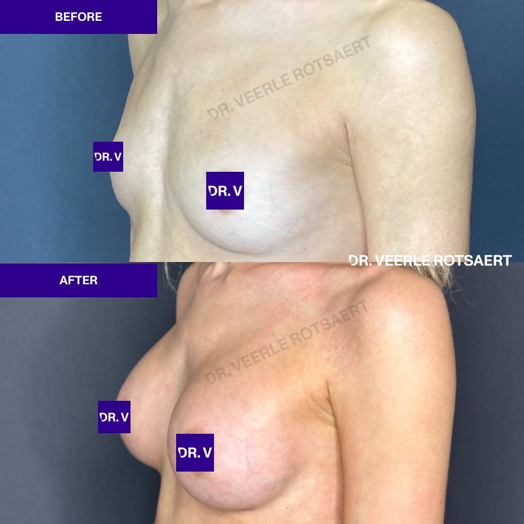 Hybrid Breast Augmentation Before & After