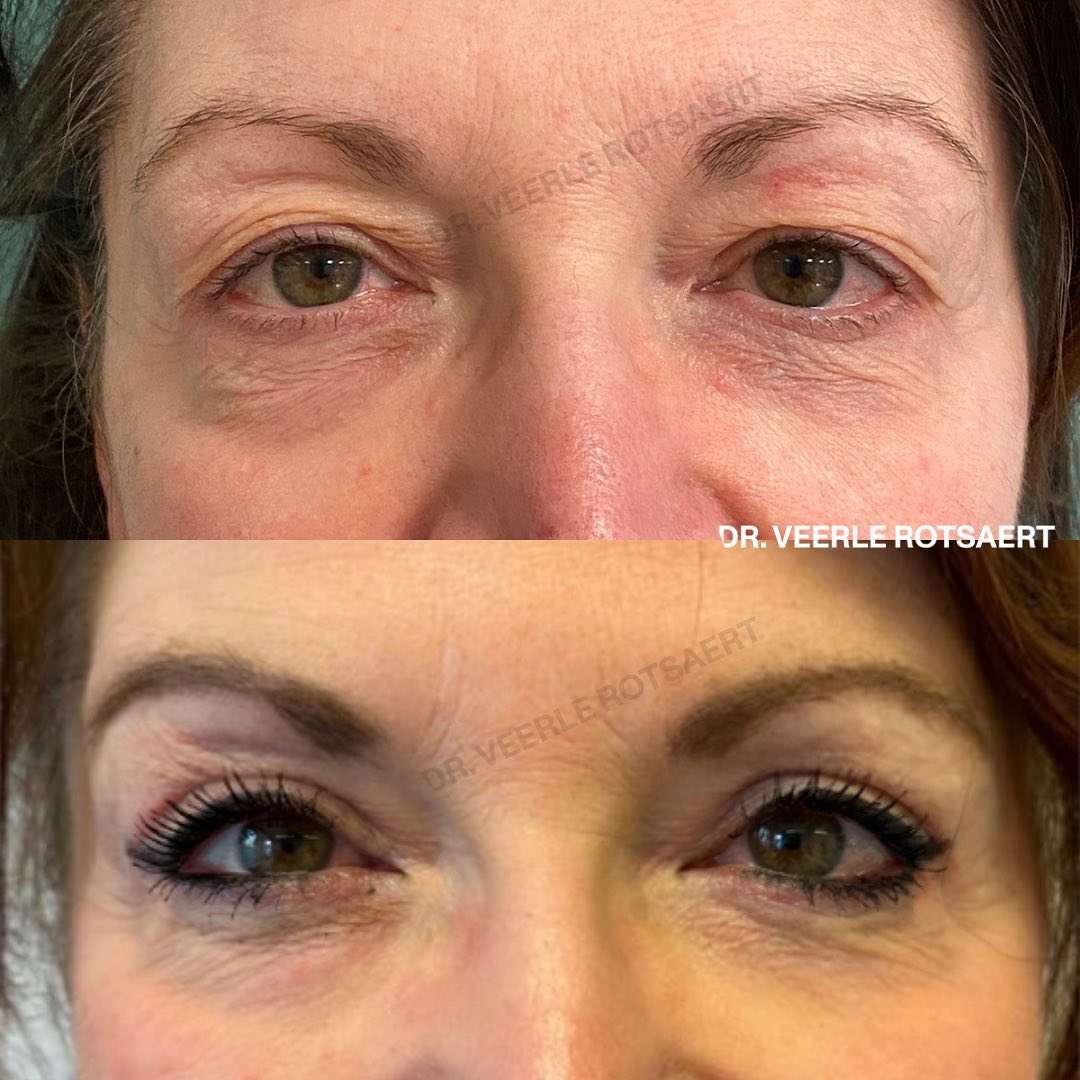 Eyelide before and after 5