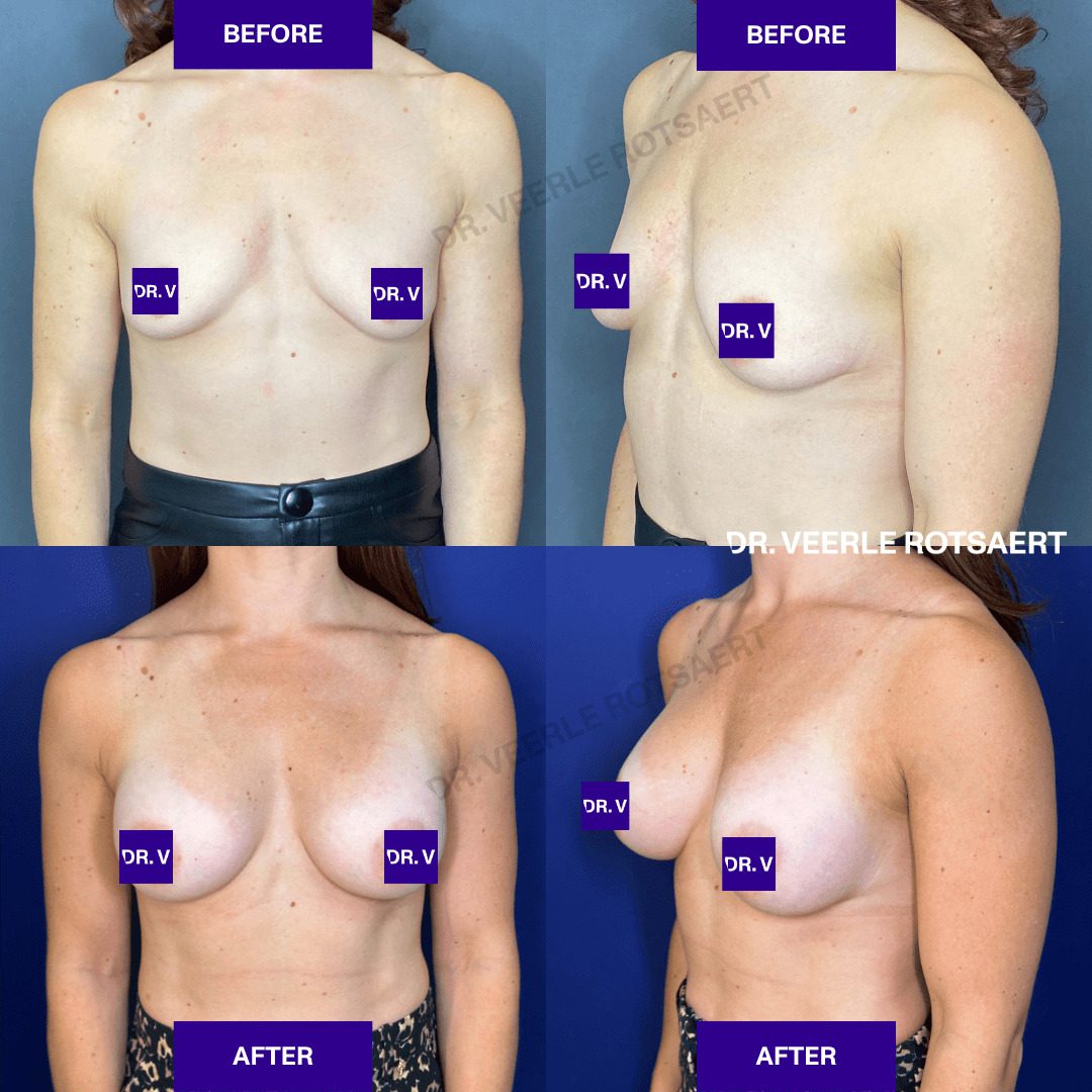 Hybrid Breast Augmentation Before & after 2