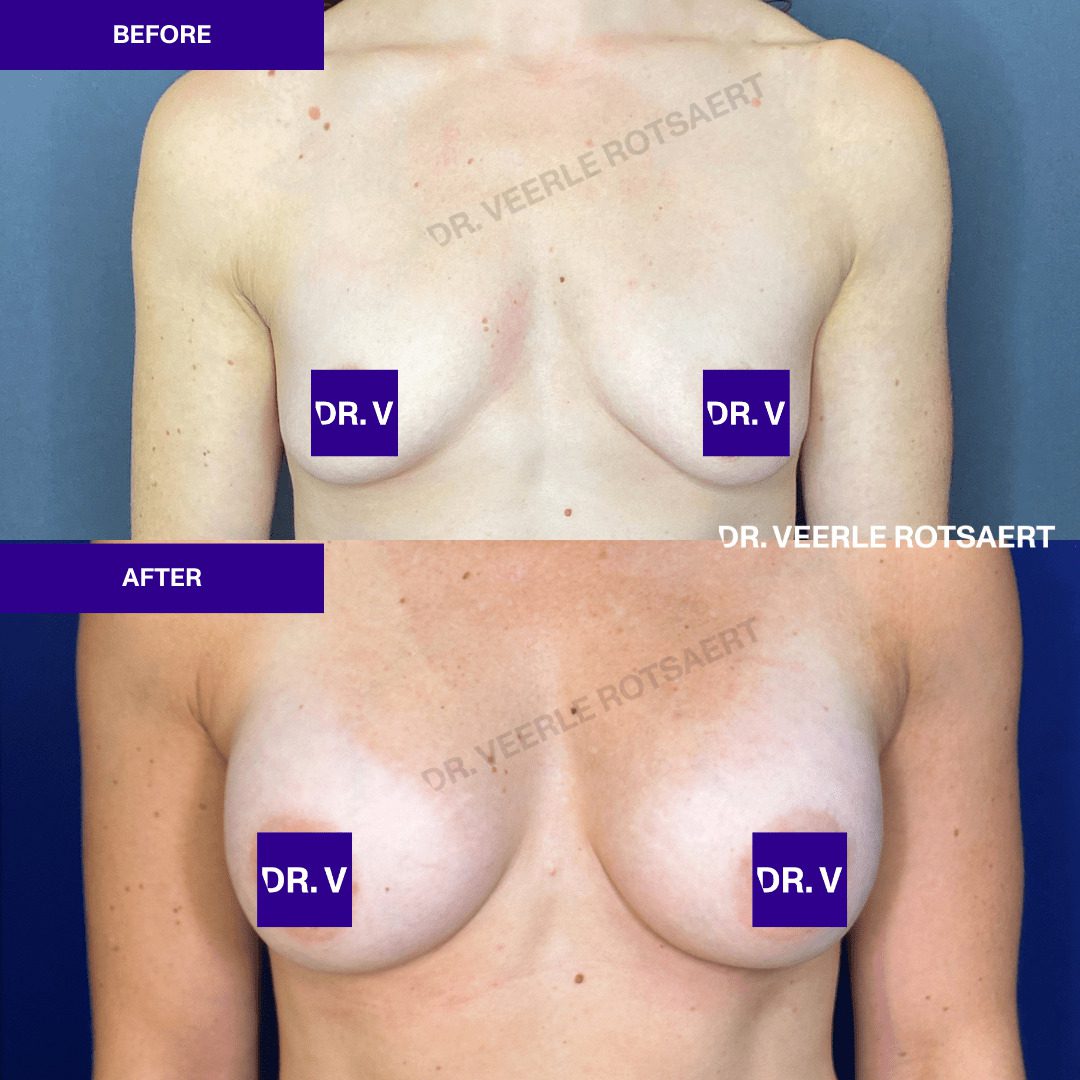 Hybrid Breast Augmentation Before & after 3