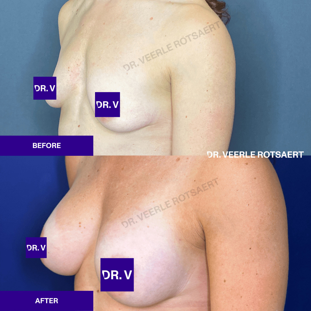 Hybrid Breast Augmentation Before & after 4